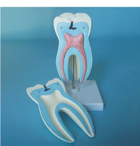 Modelo de molar con caries — VIC Science