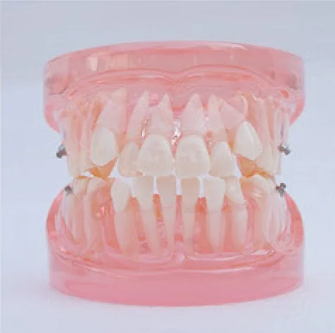 Modelo de ortodoncia transparente — VIC Science