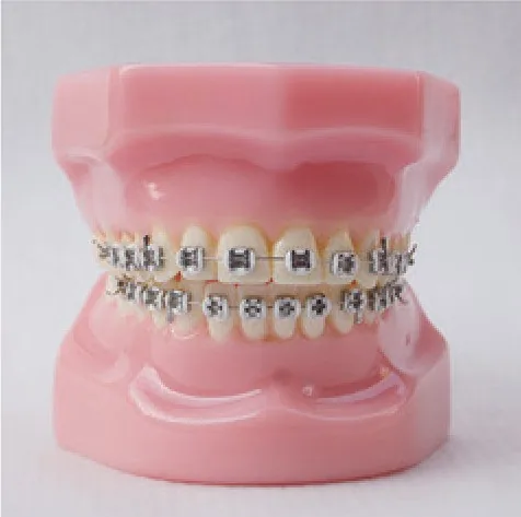 Modelo de ortodoncia con brackets metálicos — VIC Science