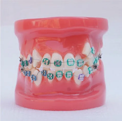 Modelo de ortodoncia con brackets metálicos y cerámicos — VIC Science