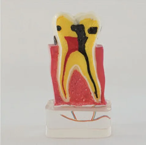 Modelo de enfermedad periodontal con nervio ampliado 4 veces — VIC Science