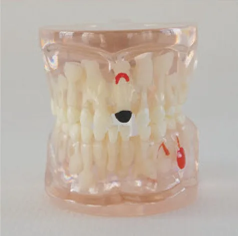 Modelo transparente de dentición mixta con caries — VIC Science