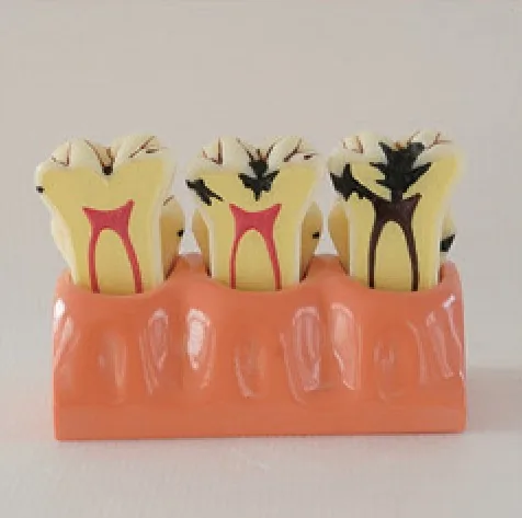 Modelo desmontable de caries ampliado 4 veces — VIC Science