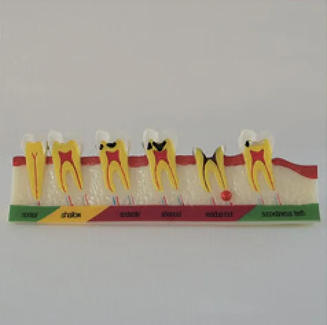 Modelo de desarrollo de caries — VIC Science